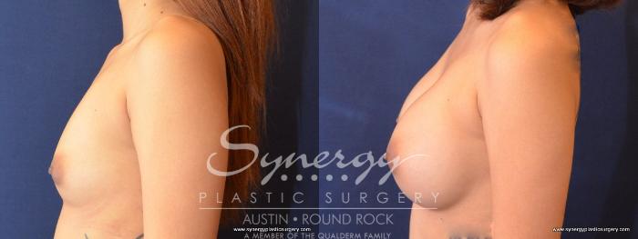Before & After Breast Augmentation Case 480 View #3 View in Austin, TX
