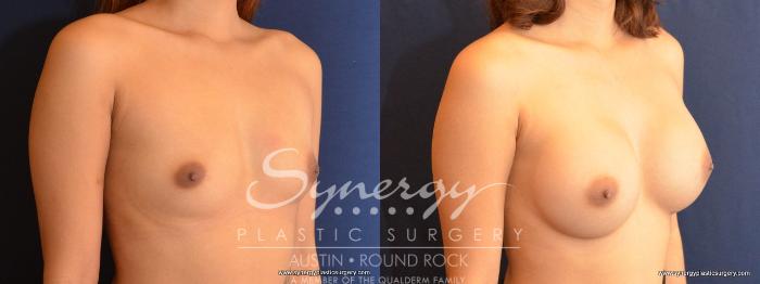 Before & After Breast Augmentation Case 480 View #4 View in Austin, TX