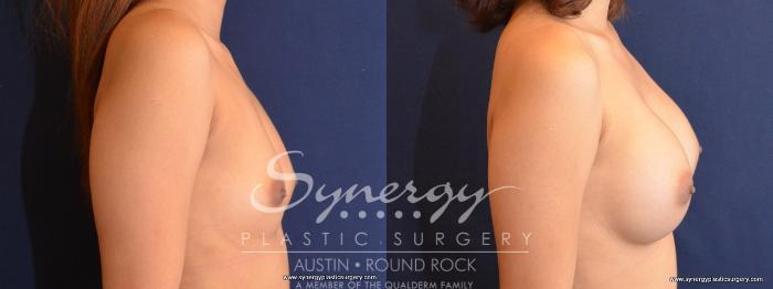 Before & After Breast Augmentation Case 480 View #5 View in Austin, TX