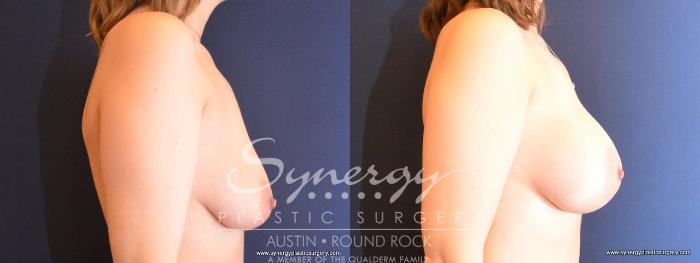 Before & After Breast Augmentation Case 481 View #5 View in Austin, TX