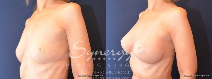 Before & After Breast Augmentation Case 486 View #2 View in Austin, TX