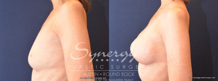 Before & After Breast Augmentation Case 486 View #3 View in Austin, TX