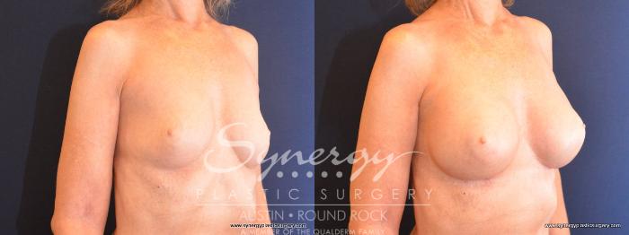 Before & After Breast Augmentation Case 486 View #4 View in Austin, TX
