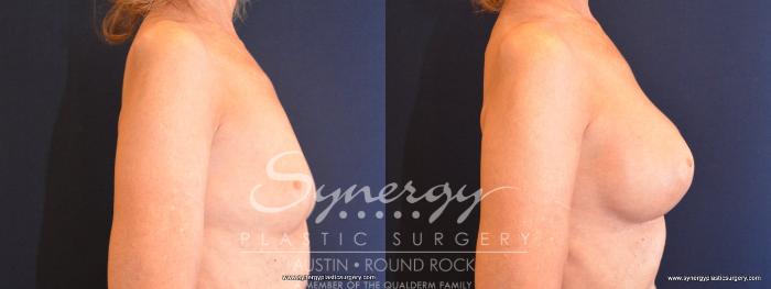 Before & After Breast Augmentation Case 486 View #5 View in Austin, TX