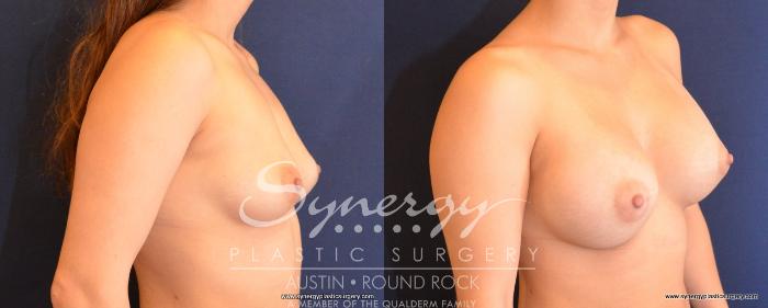 Before & After Breast Augmentation Case 491 View #2 View in Austin, TX