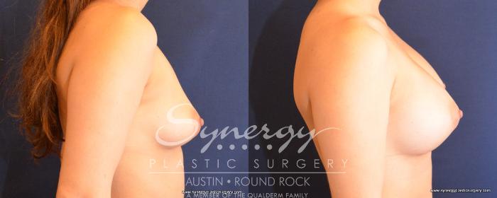 Before & After Breast Augmentation Case 491 View #3 View in Austin, TX