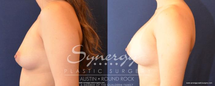 Before & After Breast Augmentation Case 491 View #5 View in Austin, TX