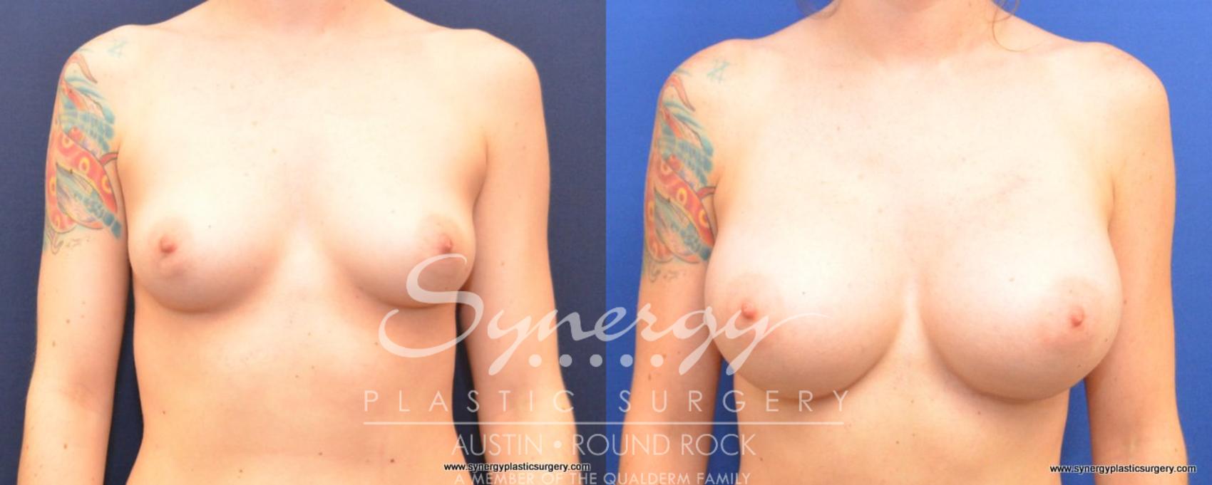 Before & After Breast Augmentation Case 492 View #1 View in Austin, TX