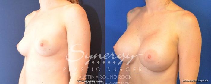 Before & After Breast Augmentation Case 492 View #2 View in Austin, TX