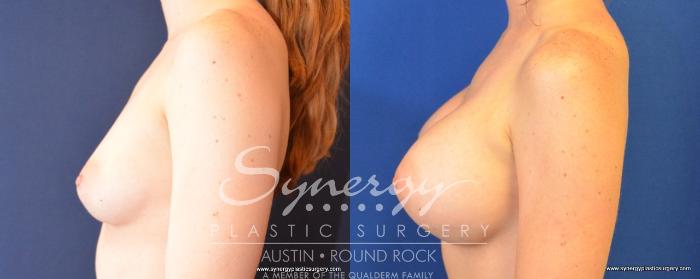 Before & After Breast Augmentation Case 492 View #3 View in Austin, TX