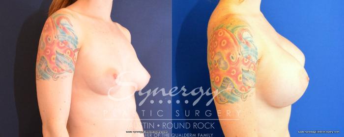 Before & After Breast Augmentation Case 492 View #4 View in Austin, TX