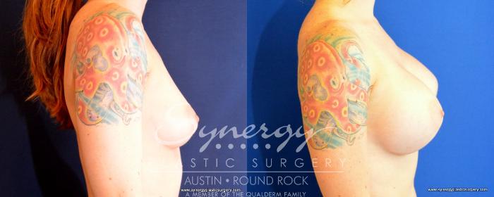 Before & After Breast Augmentation Case 492 View #5 View in Austin, TX