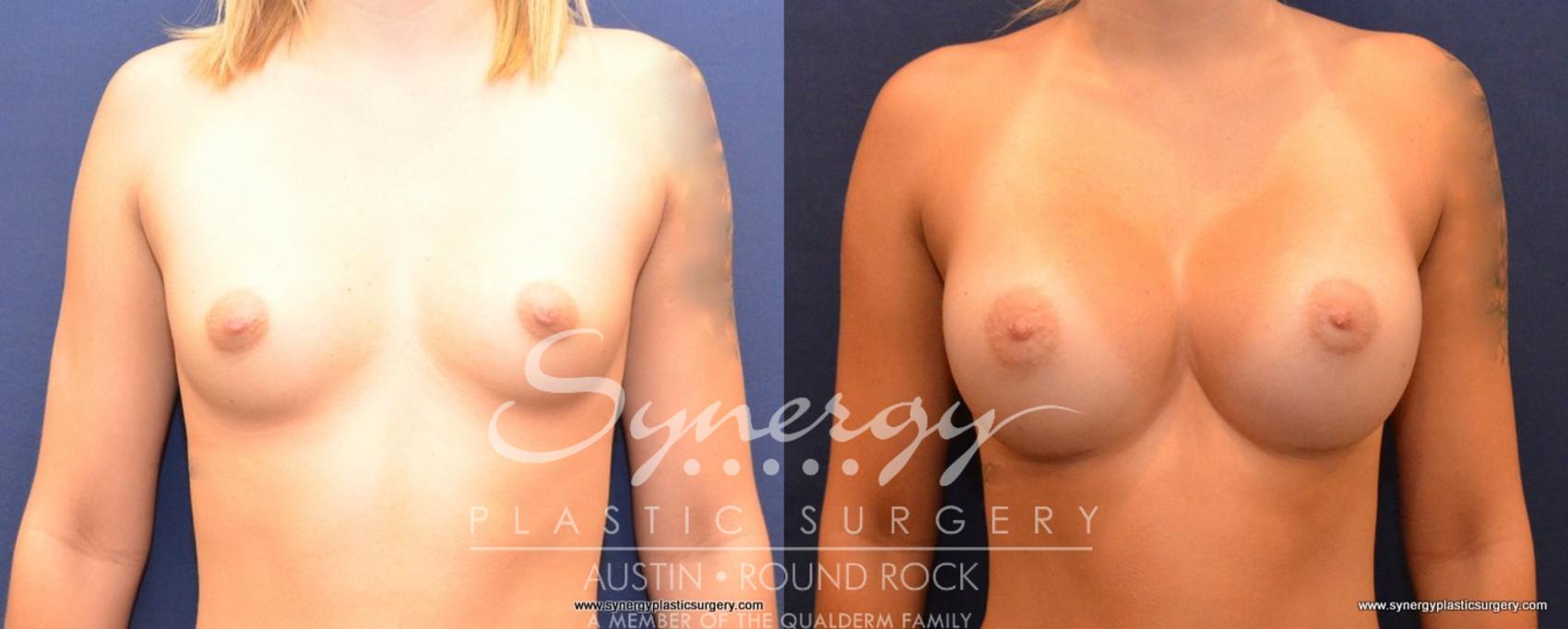 Before & After Breast Augmentation Case 494 View #1 View in Austin, TX