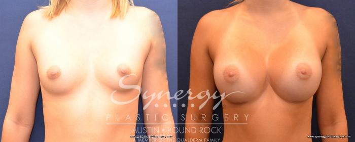 Before & After Breast Augmentation Case 494 View #1 View in Austin, TX