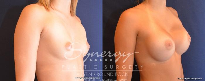 Before & After Breast Augmentation Case 494 View #2 View in Austin, TX