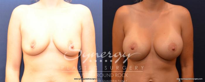 Before & After Breast Augmentation Case 500 View #1 View in Austin, TX