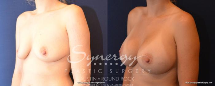 Before & After Breast Augmentation Case 500 View #2 View in Austin, TX