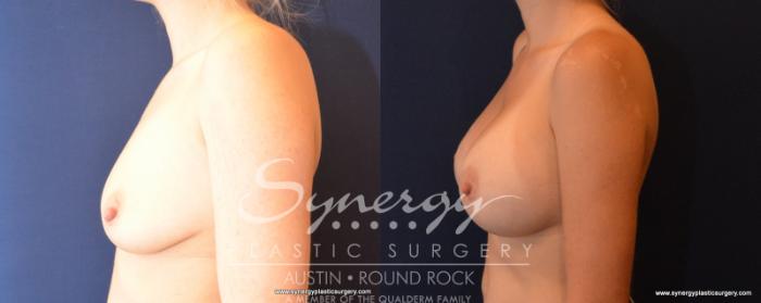 Before & After Breast Augmentation Case 500 View #3 View in Austin, TX