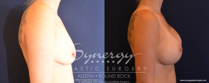 Before & After Breast Augmentation Case 500 View #5 View in Austin, TX