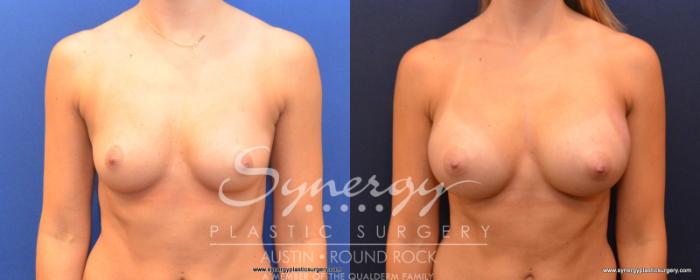 Before & After Breast Augmentation Case 502 View #1 View in Austin, TX
