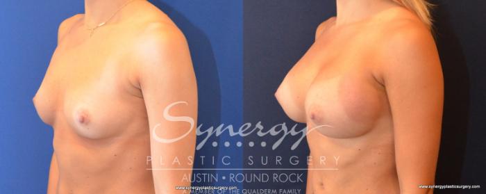 Before & After Breast Augmentation Case 502 View #2 View in Austin, TX