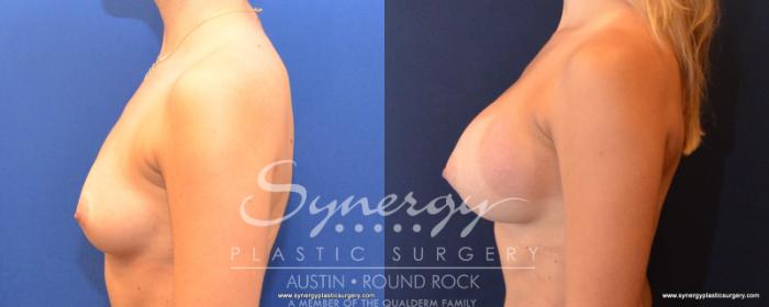 Before & After Breast Augmentation Case 502 View #3 View in Austin, TX