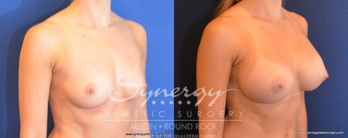 Before & After Breast Augmentation Case 502 View #4 View in Austin, TX
