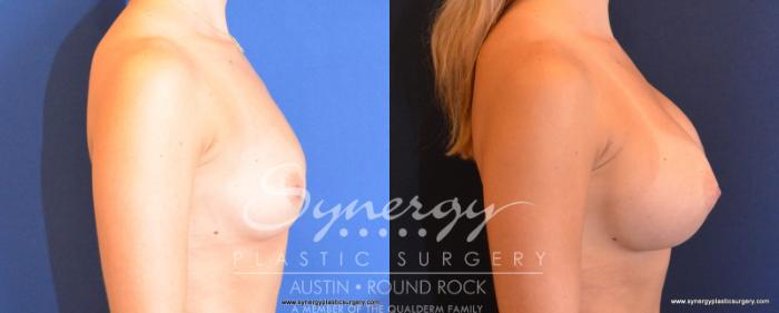 Before & After Breast Augmentation Case 502 View #5 View in Austin, TX