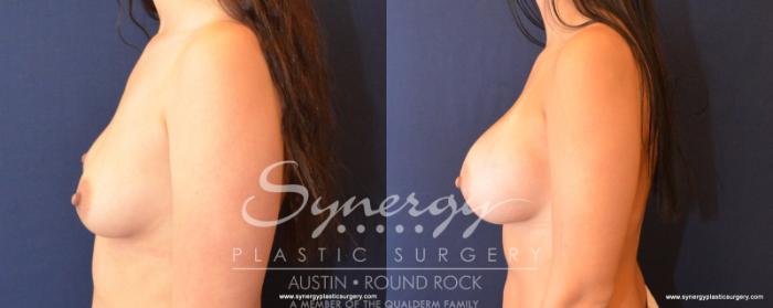 Before & After Breast Augmentation Case 504 View #3 View in Austin, TX