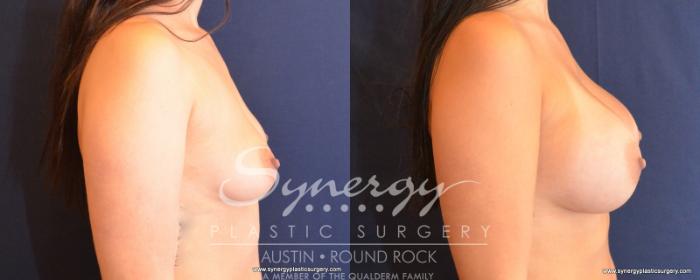 Before & After Breast Augmentation Case 504 View #4 View in Austin, TX