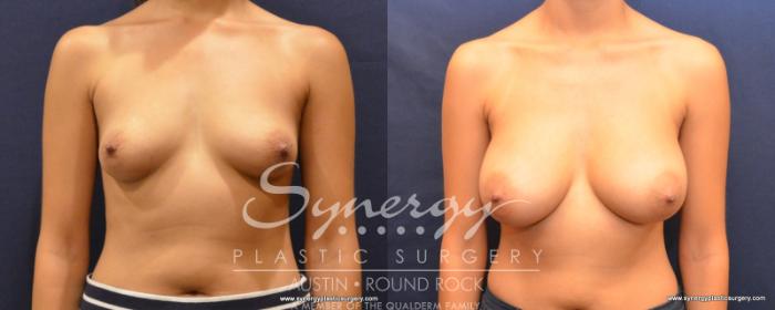 Before & After Breast Augmentation Case 506 View #1 View in Austin, TX