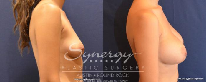 Before & After Breast Augmentation Case 506 View #2 View in Austin, TX