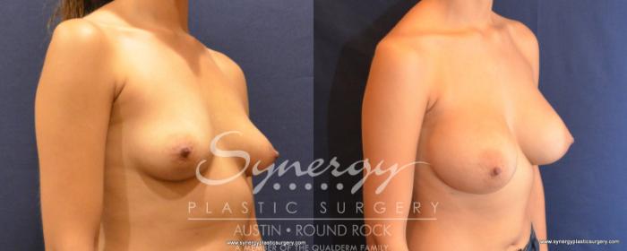Before & After Breast Augmentation Case 506 View #3 View in Austin, TX