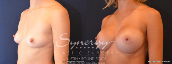 Before & After Breast Augmentation Case 512 View #2 View in Austin, TX