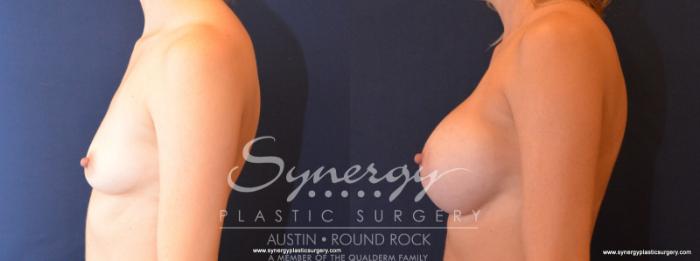 Before & After Breast Augmentation Case 512 View #3 View in Austin, TX