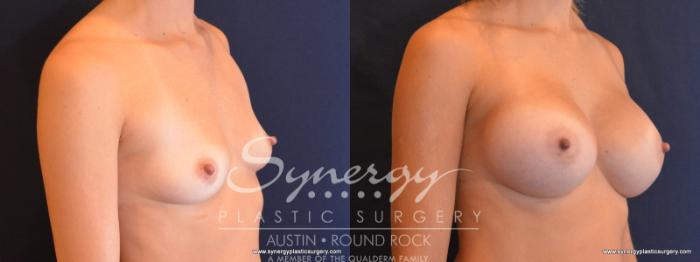 Before & After Breast Augmentation Case 512 View #4 View in Austin, TX