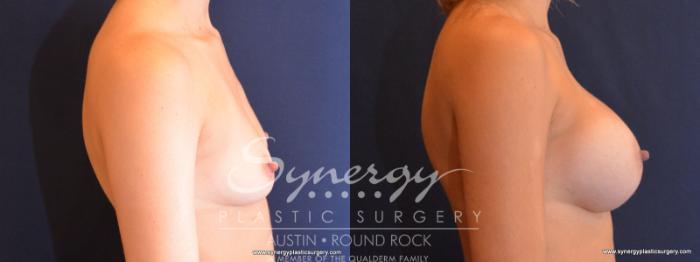 Before & After Breast Augmentation Case 512 View #5 View in Austin, TX