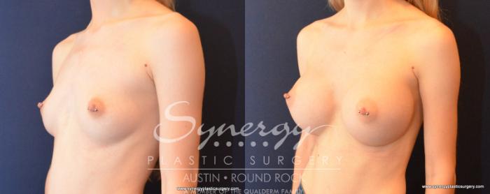 Before & After Breast Augmentation Case 513 View #2 View in Austin, TX