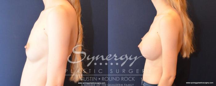 Before & After Breast Augmentation Case 513 View #3 View in Austin, TX