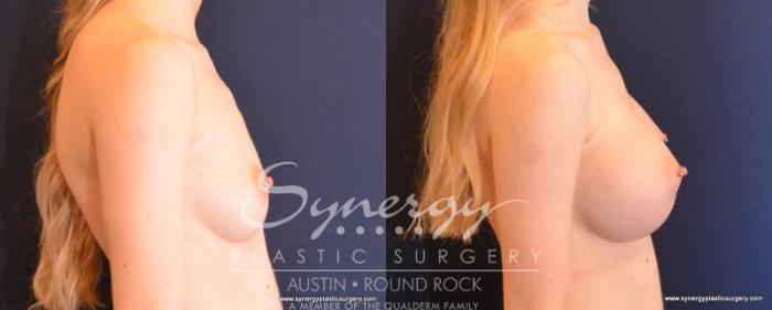 Before & After Breast Augmentation Case 513 View #4 View in Austin, TX
