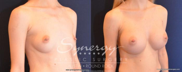 Before & After Breast Augmentation Case 513 View #5 View in Austin, TX
