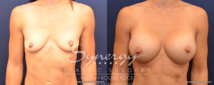 Before & After Breast Augmentation Case 519 View #1 View in Austin, TX