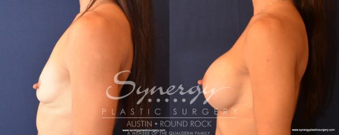 Before & After Breast Augmentation Case 519 View #3 View in Austin, TX