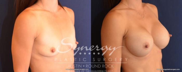Before & After Breast Augmentation Case 519 View #4 View in Austin, TX