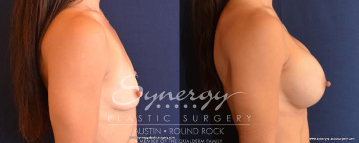 Before & After Breast Augmentation Case 519 View #5 View in Austin, TX