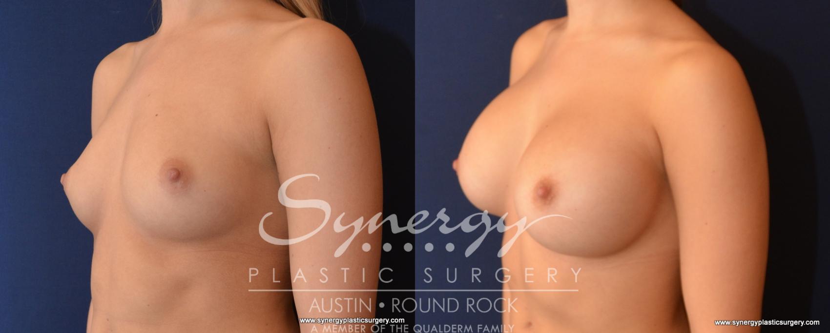 Before & After Breast Augmentation Case 523 View #1 View in Austin, TX