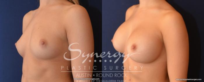 Before & After Breast Augmentation Case 523 View #1 View in Austin, TX