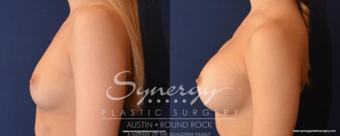 Before & After Breast Augmentation Case 523 View #2 View in Austin, TX
