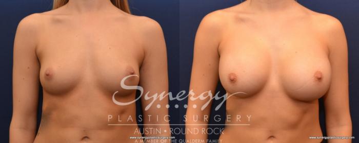 Before & After Breast Augmentation Case 523 View #3 View in Austin, TX