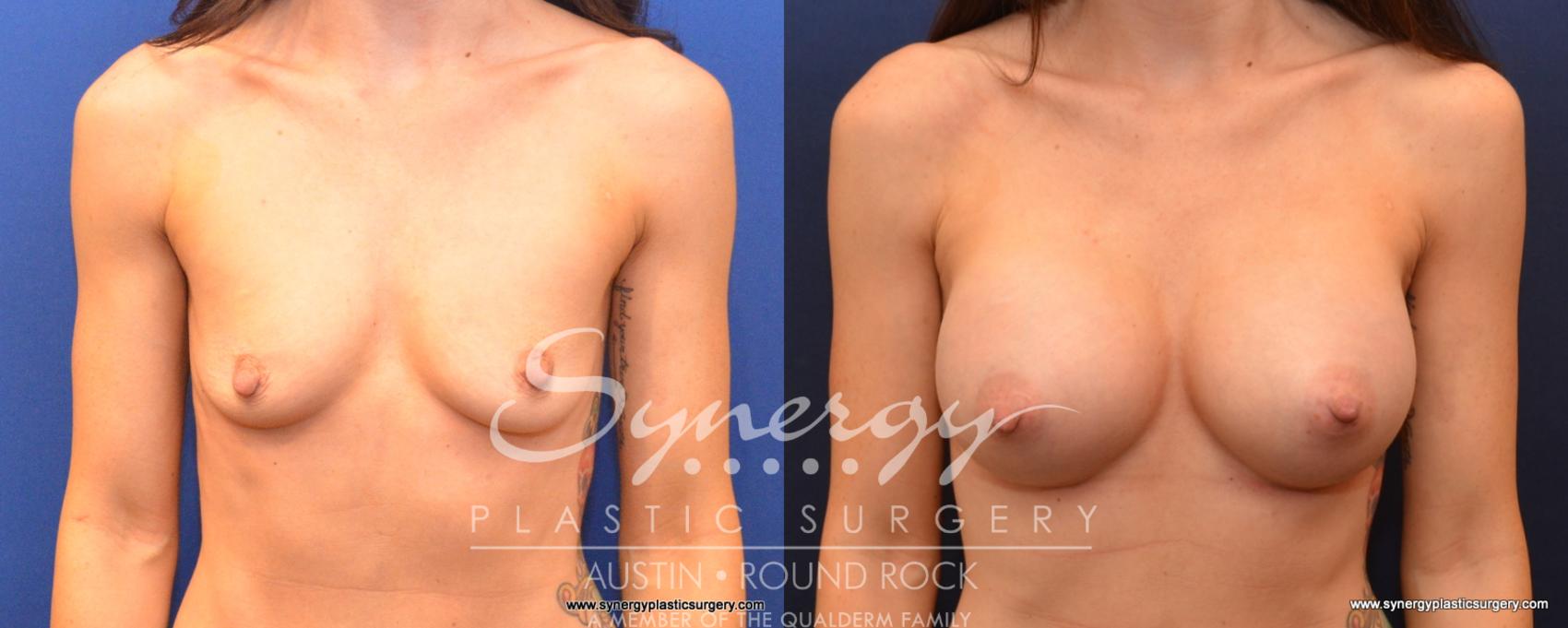 Before & After Breast Augmentation Case 529 View #1 View in Austin, TX